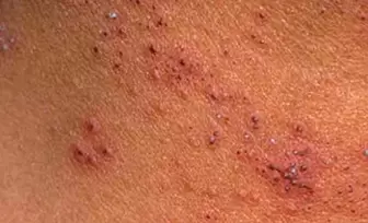 Multiple Papillome op der Haut