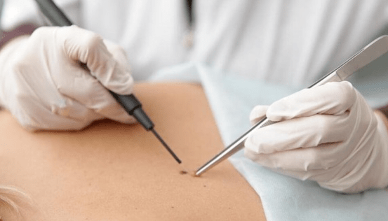 Features vun der Entfernung vu Papilloma