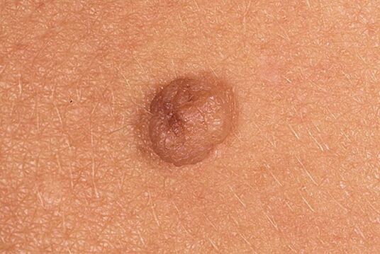 Einfach Papilloma