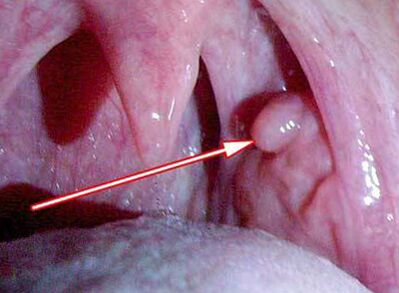 Papilloma am Larynx