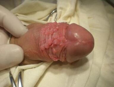 Papilloma op engem Member