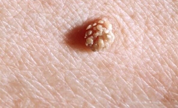 Papilloma um mënschleche Kierper