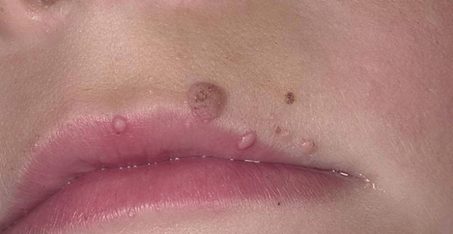 Papillomas op de Lippen