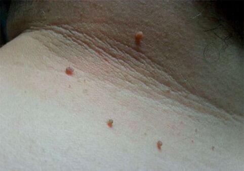 Papillomas um Hals