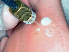 Kryodestruktioun als Method fir Plantarwarzentfernung